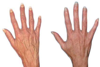 Effect of Neoveris for the treatment of varicose veins on the hands