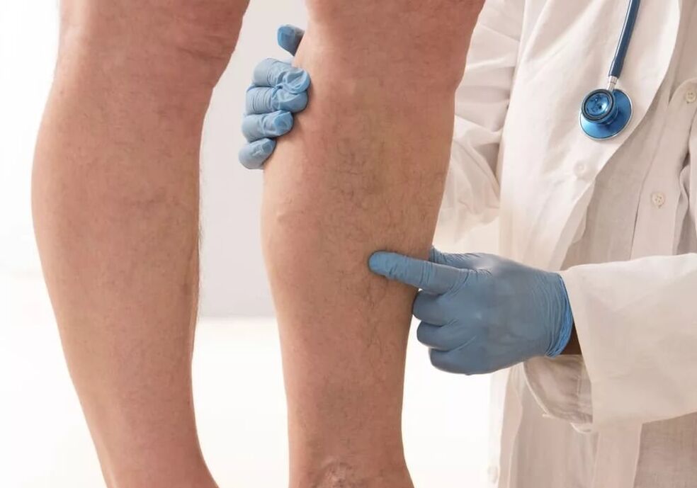 Treatment of varicose veins
