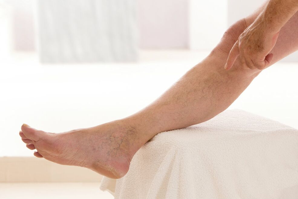 Varicose veins on the legs
